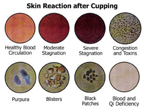 cupping